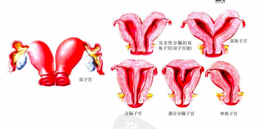 异常发育的子宫