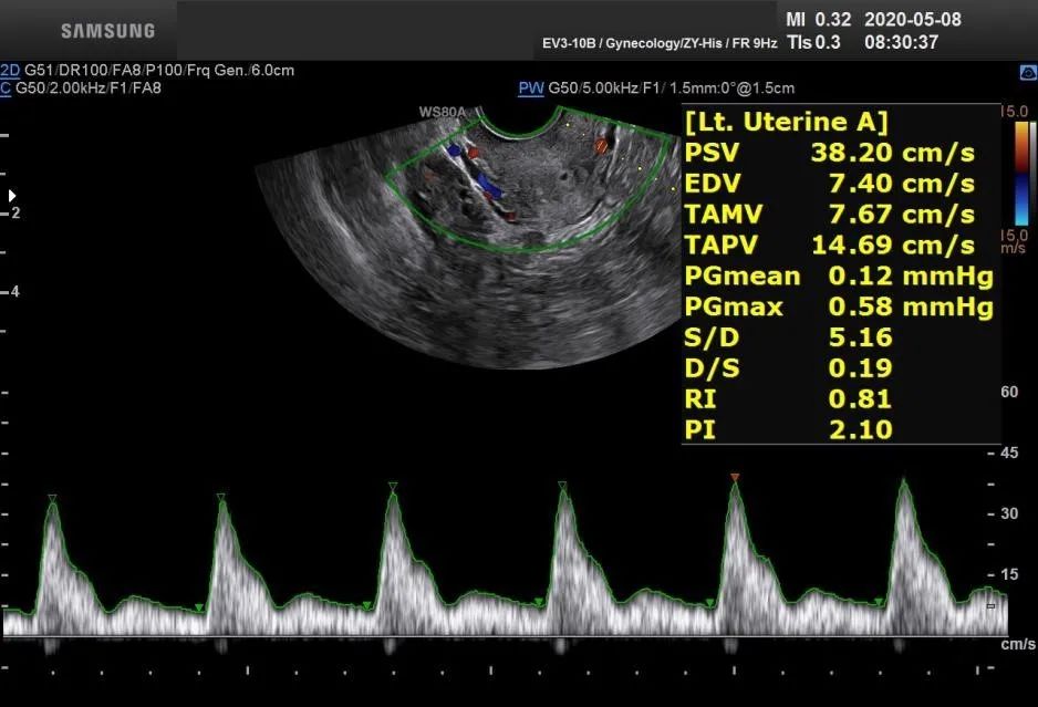 子宫动脉的阻力指数