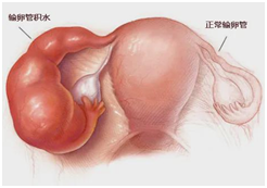 输卵管积水