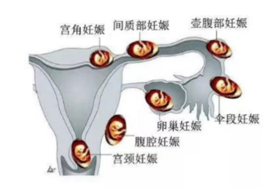 移植后可能会宫内宫外同时怀孕？那能保住宫内的宝宝吗？