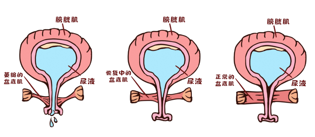 经常吸烟的女性，或者是患有慢性呼吸系统疾病(哮喘、囊性纤维化、支气管炎)，会增加压力性尿失禁的患病率。