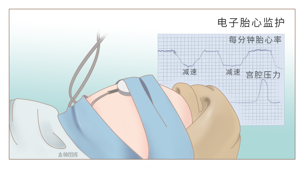 通过监测胎心率变化和宫缩压力，能及时发现胎儿缺氧、脐带绕颈等风险